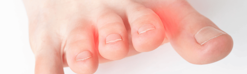 La polyarthrite rhumatoïde et sa prise en charge podologique